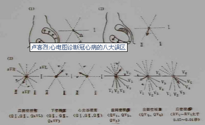 心电图对心梗部位的定位